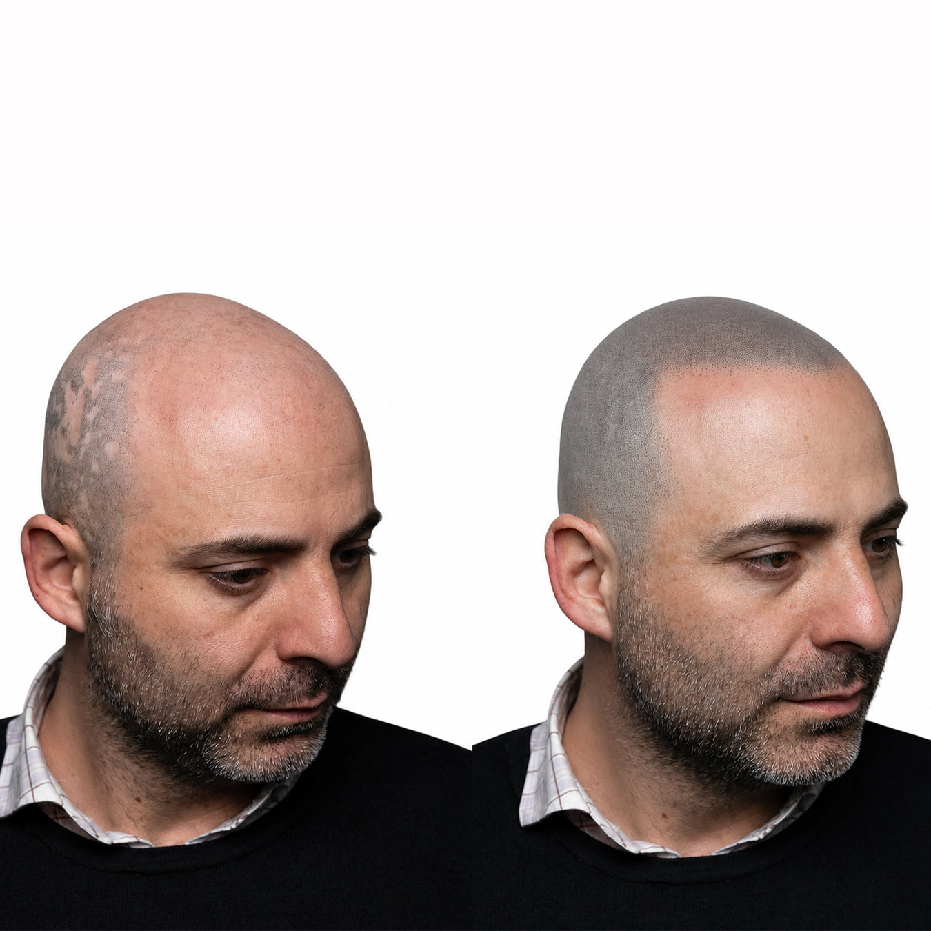 Before and after scalp micropigmentation, the main steps