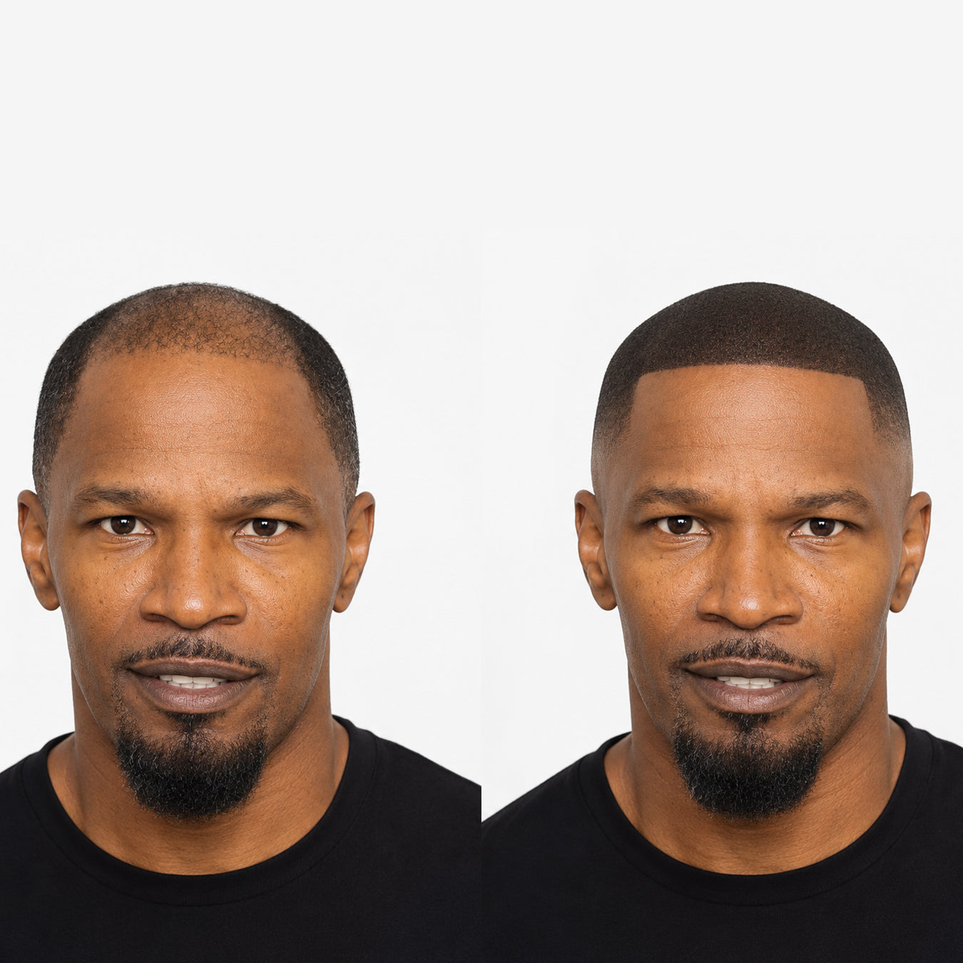 Scalp micropigmentation of celebrities and more smp answers