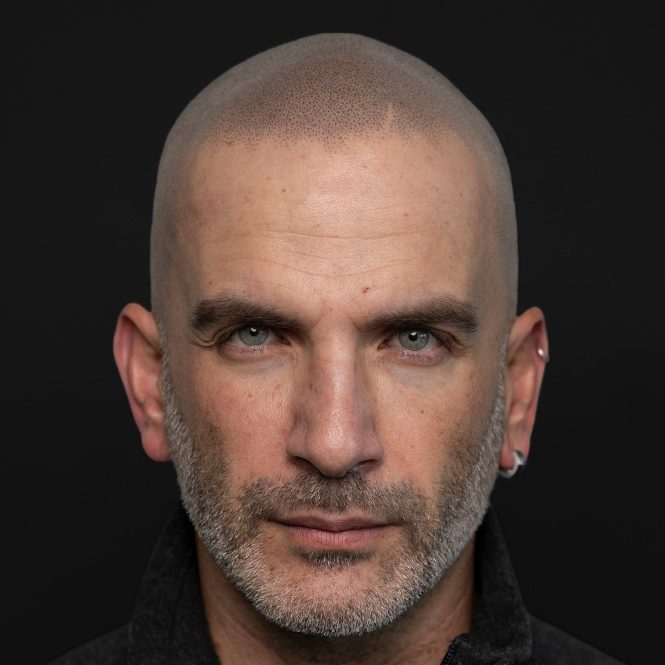 Does scalp micropigmentation look real?