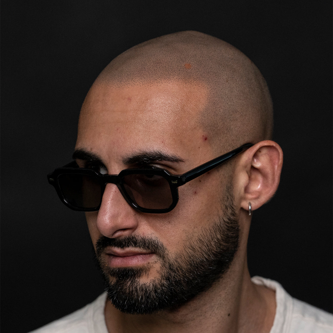 Botched scalp micropigmentation: what to do after?