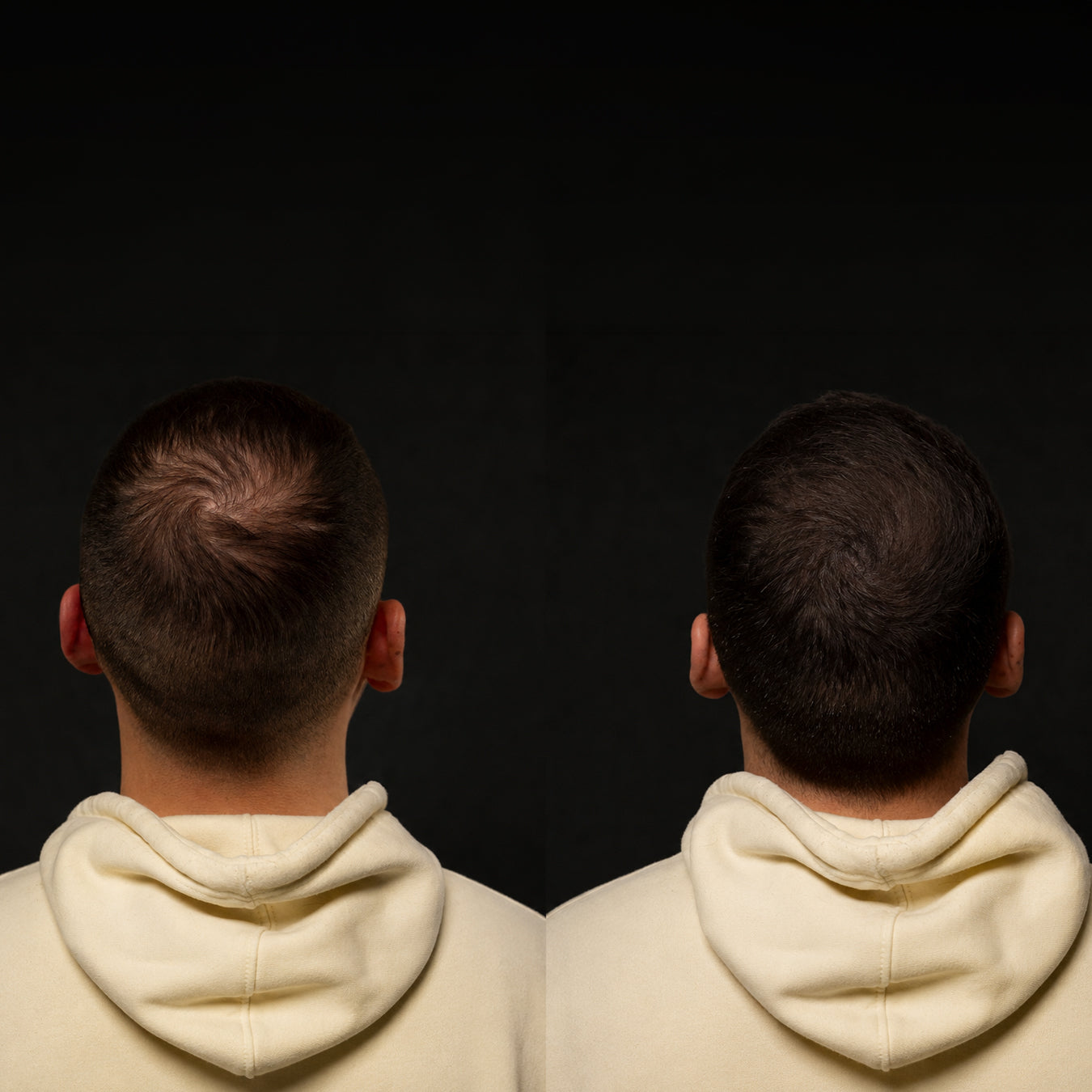 Scalp tattoo for thinning hair to thicken, how it works