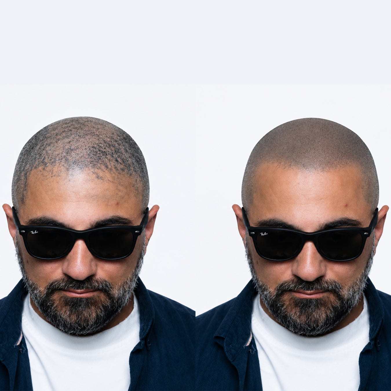 Scalp micropigmentation looks fake? Yes, when you do bad smp